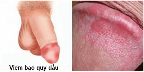 Viêm bao quy đầu có tự khỏi không?