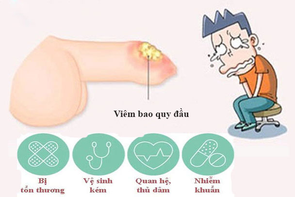 Nguyên nhân gây bệnh viêm bao quy đầu.